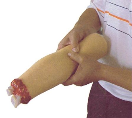 트라우마 간호 치료 모델 팔 절단 및 위 다리 상처 치료에 대한 혈전