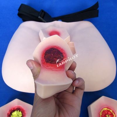환자 돌봄 시범 압력 상처 간호 모델 단계 침상 상처 교육 모델